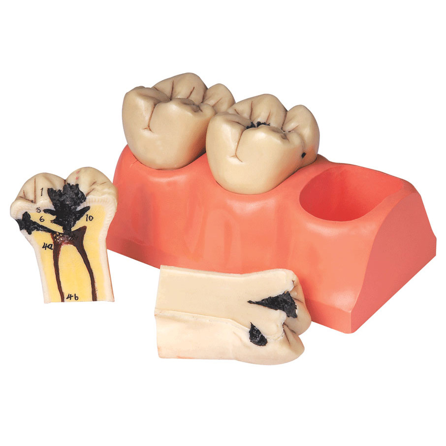 牙齒病變模型